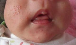 全国花粉过敏预警地图